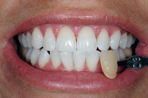 After teeth whitening