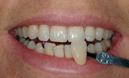 Before teeth whitening