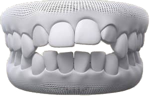 Open bite
